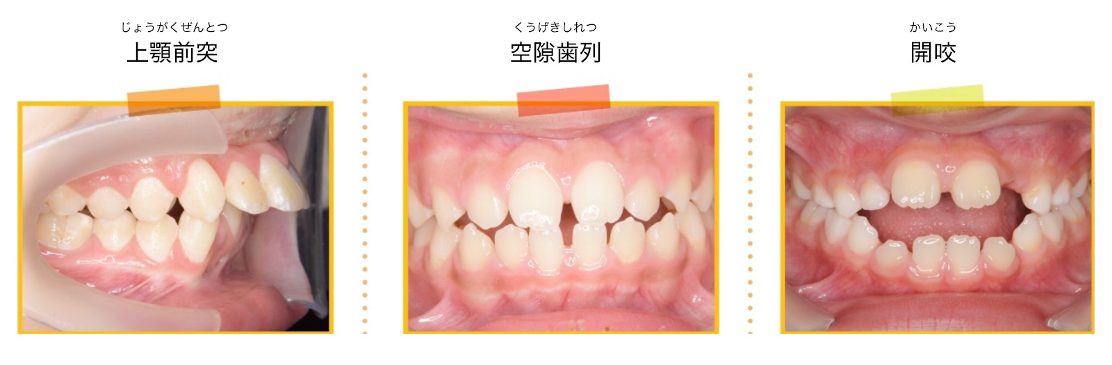 MFT（口腔筋機能療法） | 東戸塚 たいらく矯正歯科