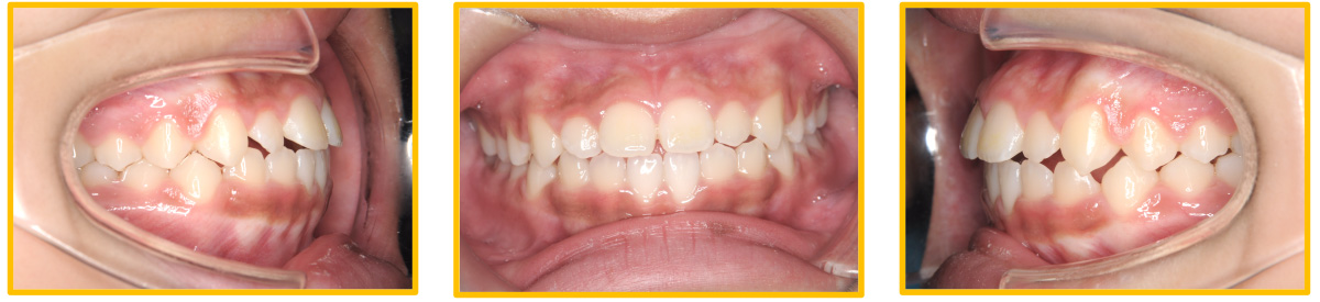 MFT（口腔筋機能療法） | 東戸塚 たいらく矯正歯科